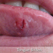 啮舌 