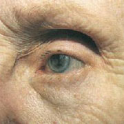 眼球运动障碍