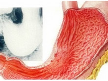 胃黏膜充血