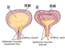 膀胱残余尿量增多