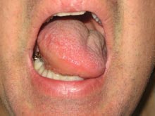 舌水肿