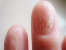 手指甲有白色斑点