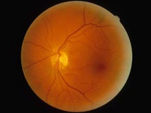 视网膜动静脉交叉征