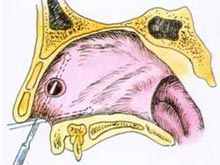 鼻中隔穿孔