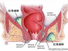 寒邪凝滞肛周痈肿