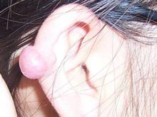 耳孔处肿物 