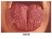 舌体大且表面有沟纹 