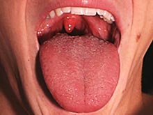 舌根部脓肿 
