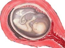 妊娠时伴有腹痛的阴道流血