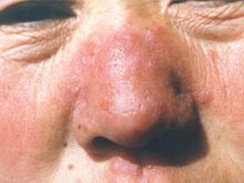 鼻尖或鼻翼出现带状疱疹