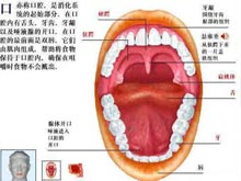 舌位于口腔底不能外伸 