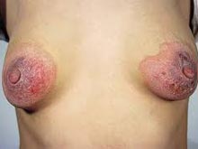 乳房湿疹