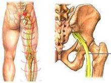 腰臀部广泛性疼痛并向下放射