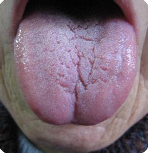 裂纹舌