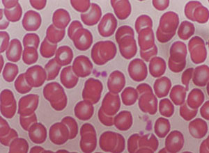 红细胞呈钱串状 
