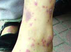 小腿和踝关节周围的紫红色瘀斑