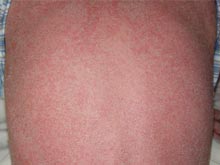 皮肤潮红肿胀是指皮肤看上去比一般正常肤色红,边界呈圆形,有点