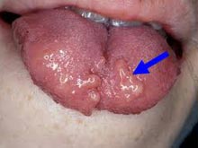 舌头火疮的症状图片图片